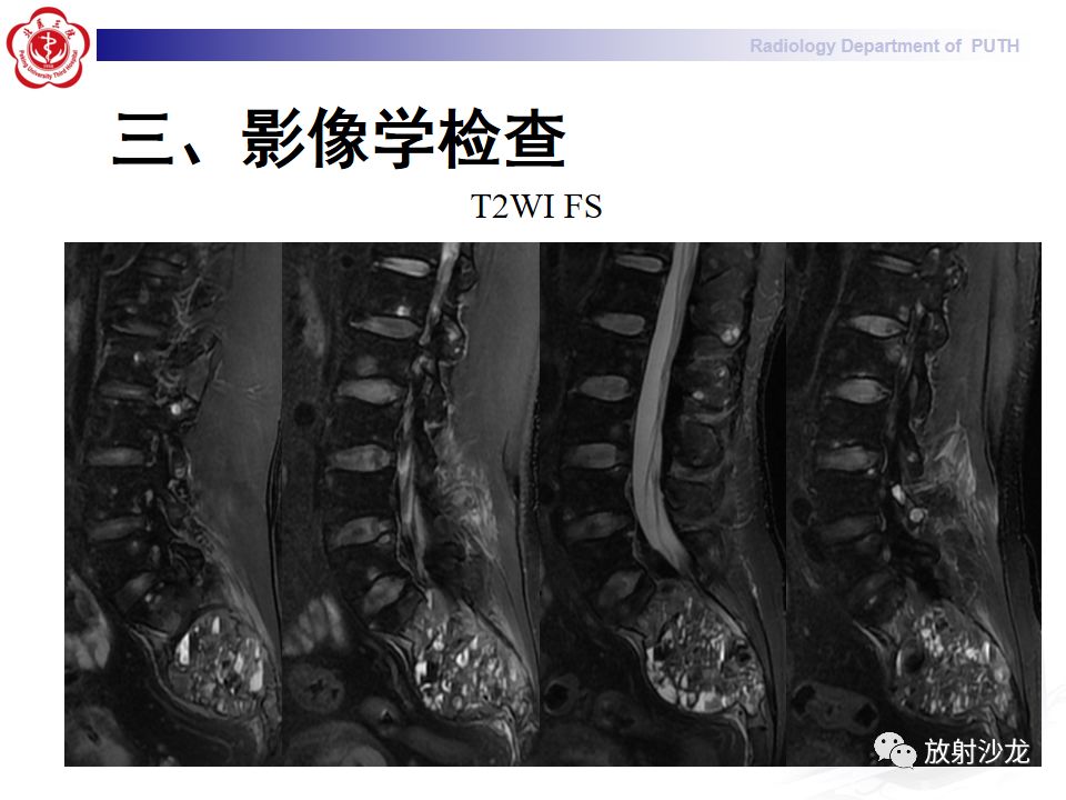 【病例】骶骨转移瘤1例CT及MR影像表现