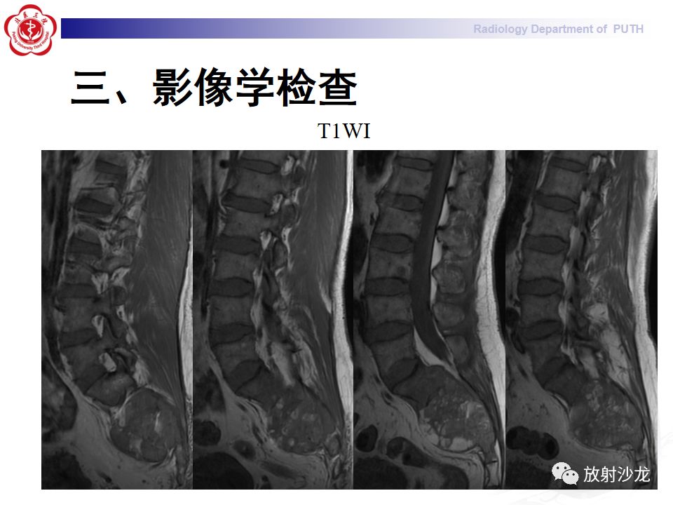 【病例】骶骨转移瘤1例CT及MR影像表现