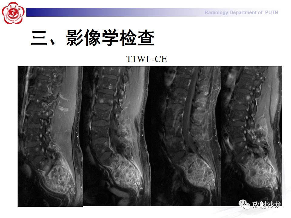 【病例】骶骨转移瘤1例CT及MR影像表现