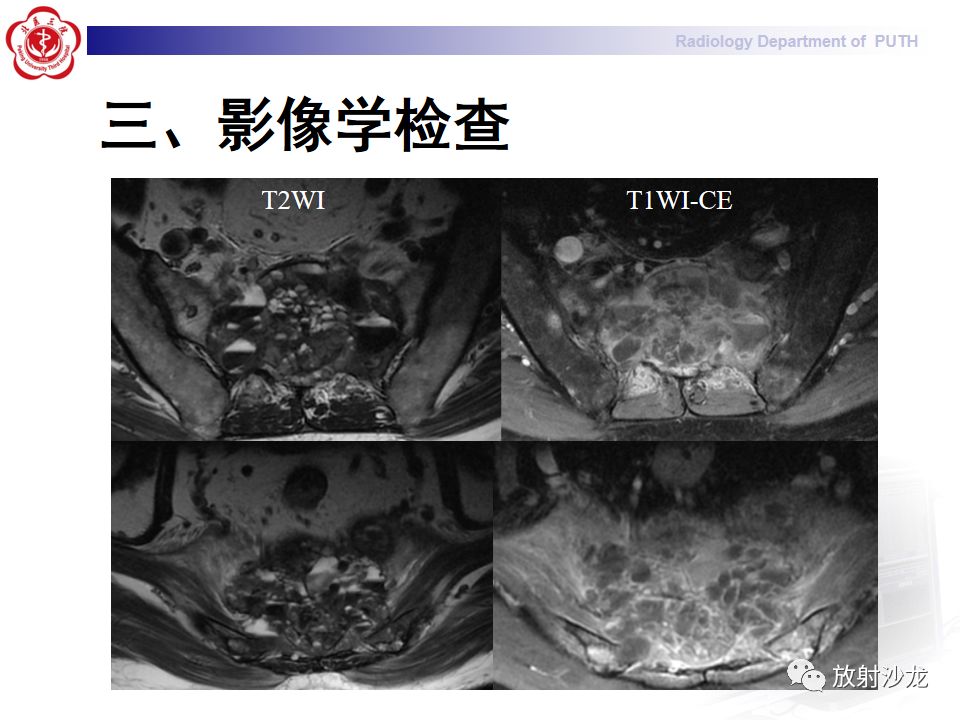 【病例】骶骨转移瘤1例CT及MR影像表现