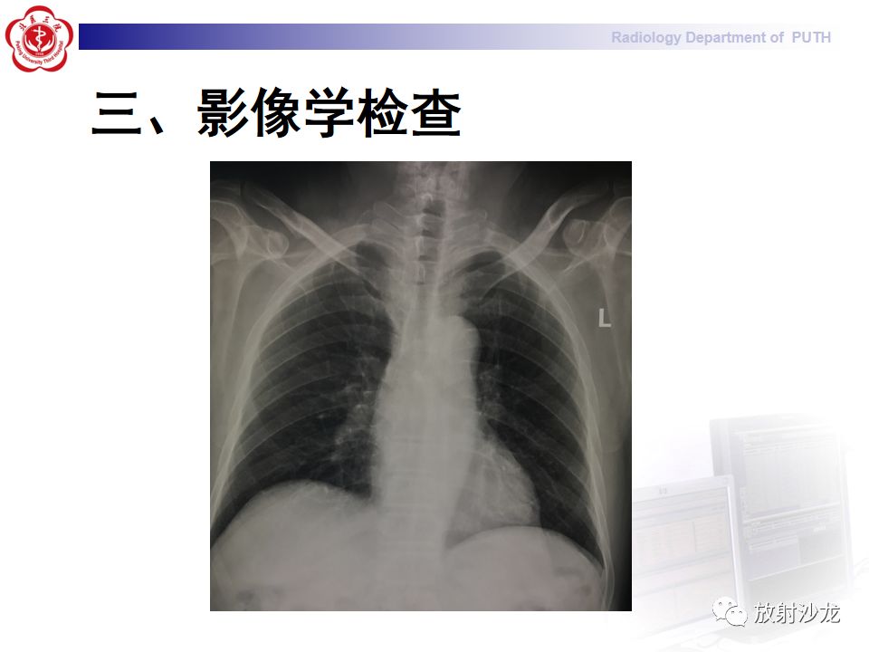 【病例】骶骨转移瘤1例CT及MR影像表现