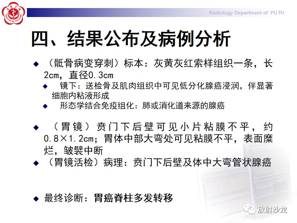 【病例】骶骨转移瘤1例CT及MR影像表现