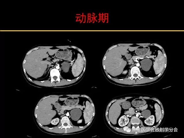 【病例】肾上腺神经节细胞瘤1例CT影像表现