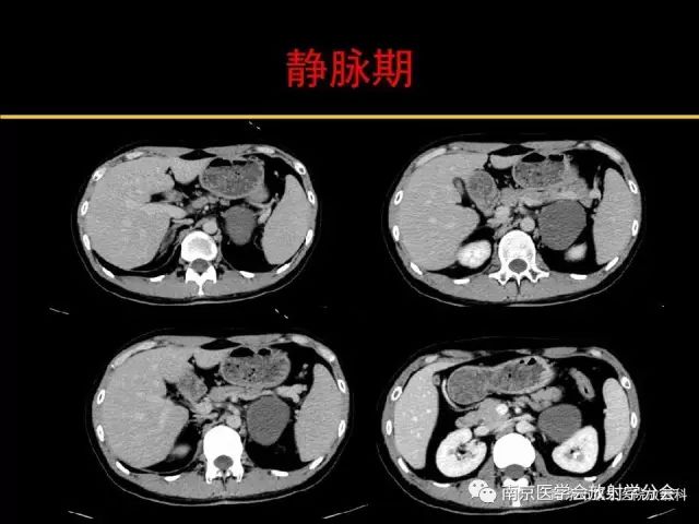 【病例】肾上腺神经节细胞瘤1例CT影像表现