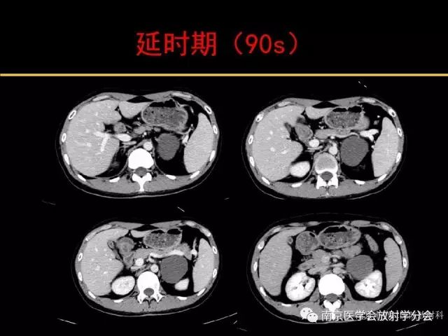 【病例】肾上腺神经节细胞瘤1例CT影像表现