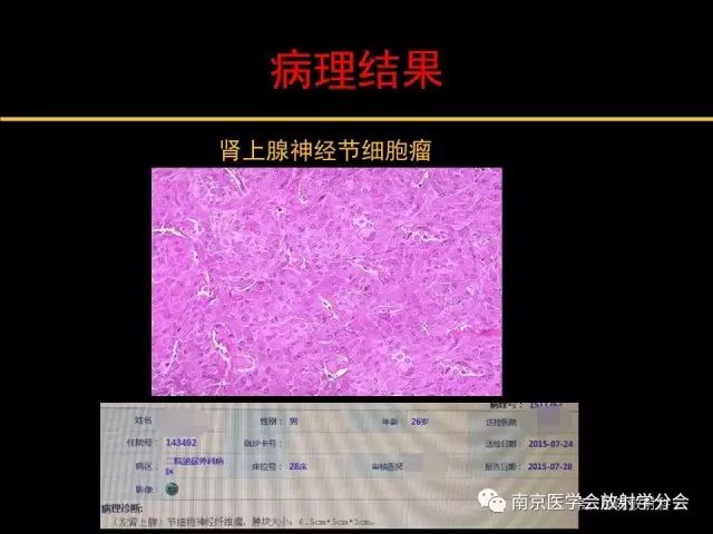 【病例】肾上腺神经节细胞瘤1例CT影像表现