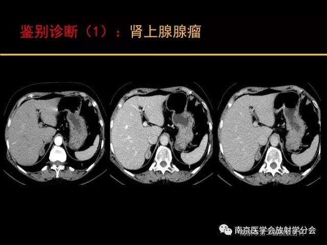 【病例】肾上腺神经节细胞瘤1例CT影像表现