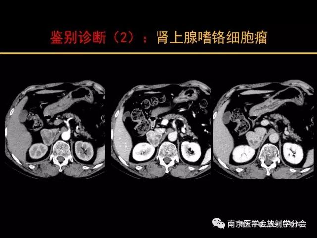 【病例】肾上腺神经节细胞瘤1例CT影像表现