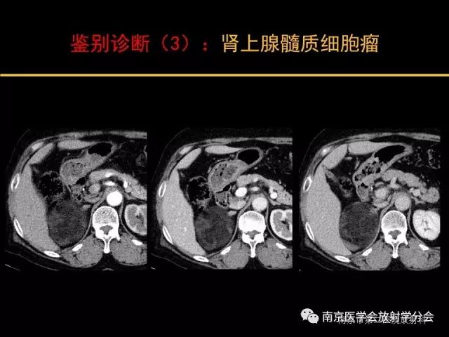 【病例】肾上腺神经节细胞瘤1例CT影像表现