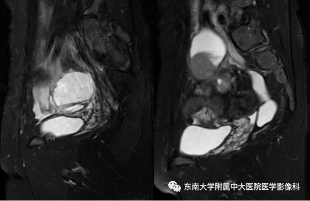 【病例】卵巢子宫内膜样癌2例MR影像表现