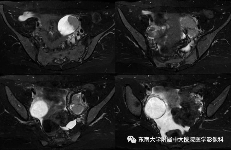 【病例】卵巢子宫内膜样癌2例MR影像表现