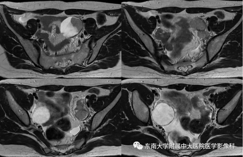【病例】卵巢子宫内膜样癌2例MR影像表现
