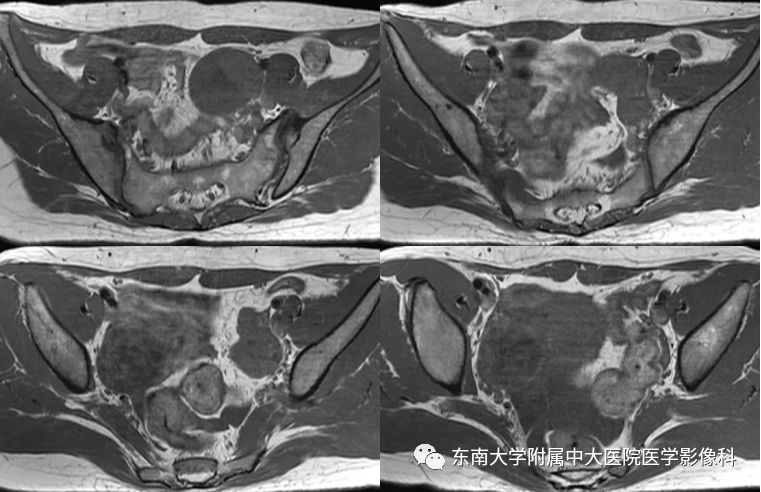 【病例】卵巢子宫内膜样癌2例MR影像表现