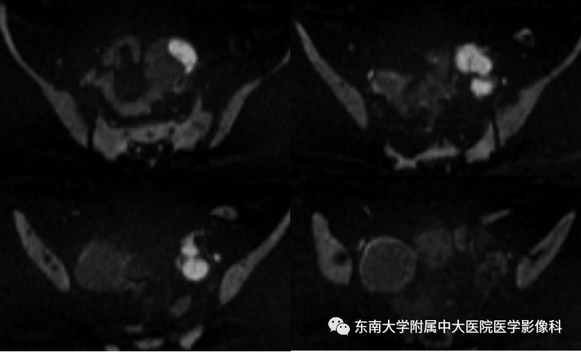 【病例】卵巢子宫内膜样癌2例MR影像表现