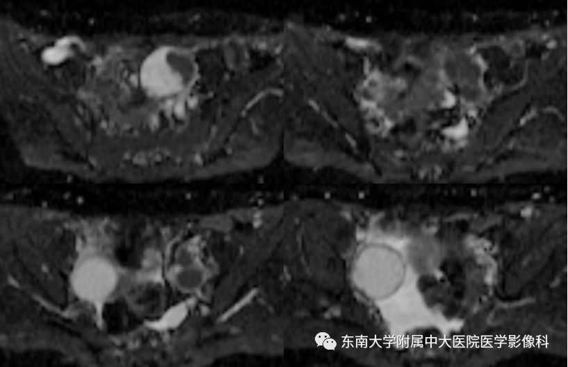 【病例】卵巢子宫内膜样癌2例MR影像表现