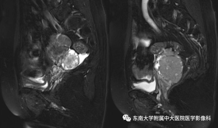 【病例】卵巢子宫内膜样癌2例MR影像表现