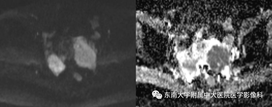 【病例】卵巢子宫内膜样癌2例MR影像表现