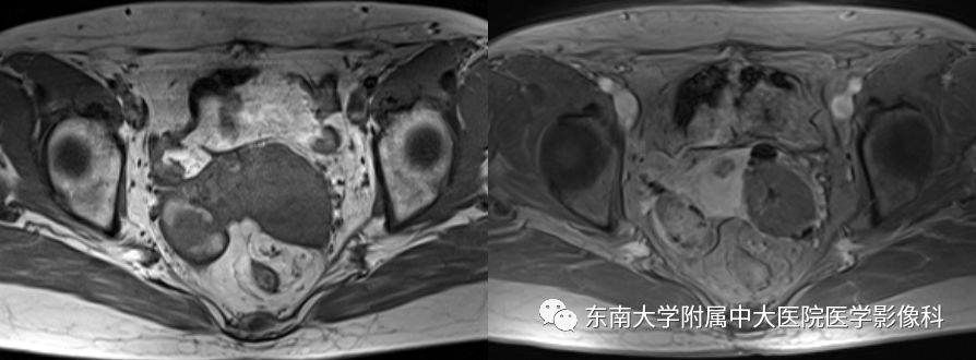 【病例】卵巢子宫内膜样癌2例MR影像表现