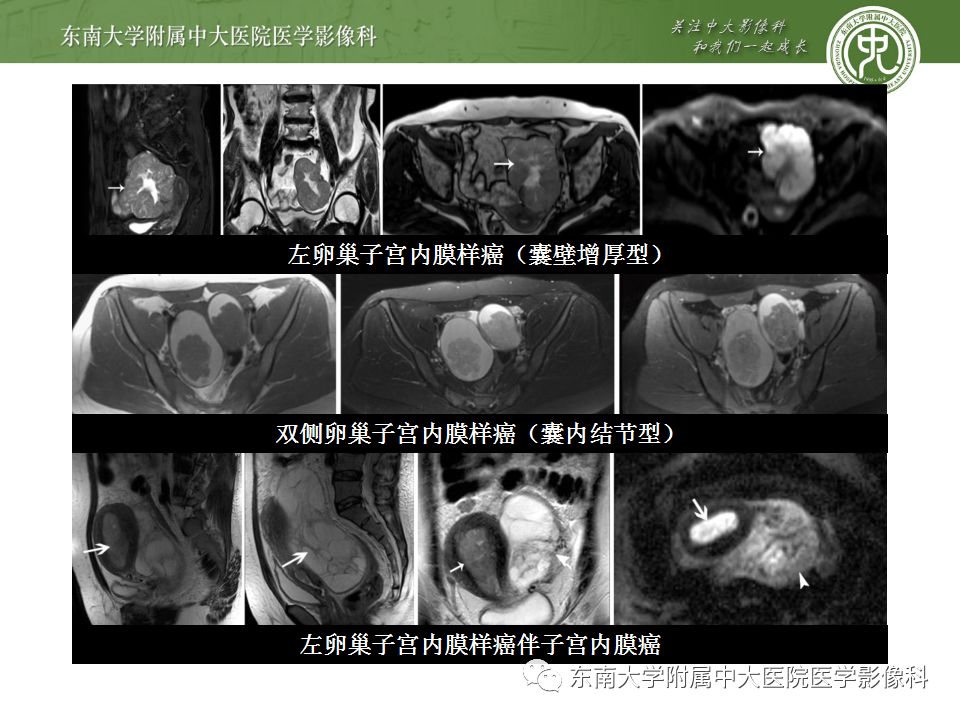 【病例】卵巢子宫内膜样癌2例MR影像表现