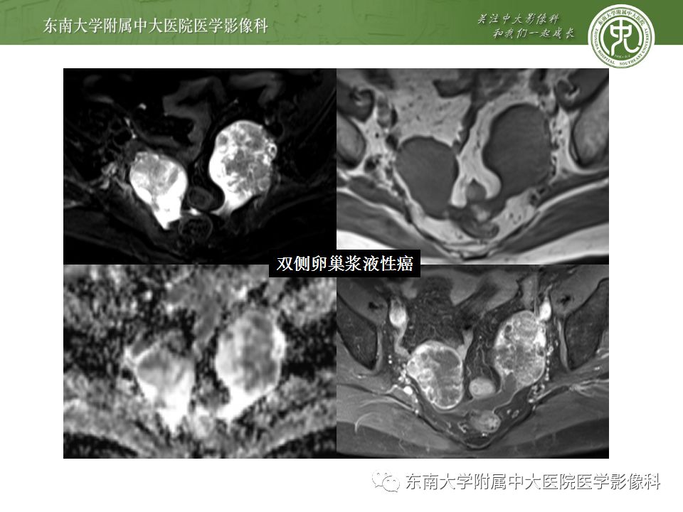 【病例】卵巢子宫内膜样癌2例MR影像表现