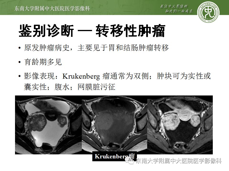 【病例】卵巢子宫内膜样癌2例MR影像表现