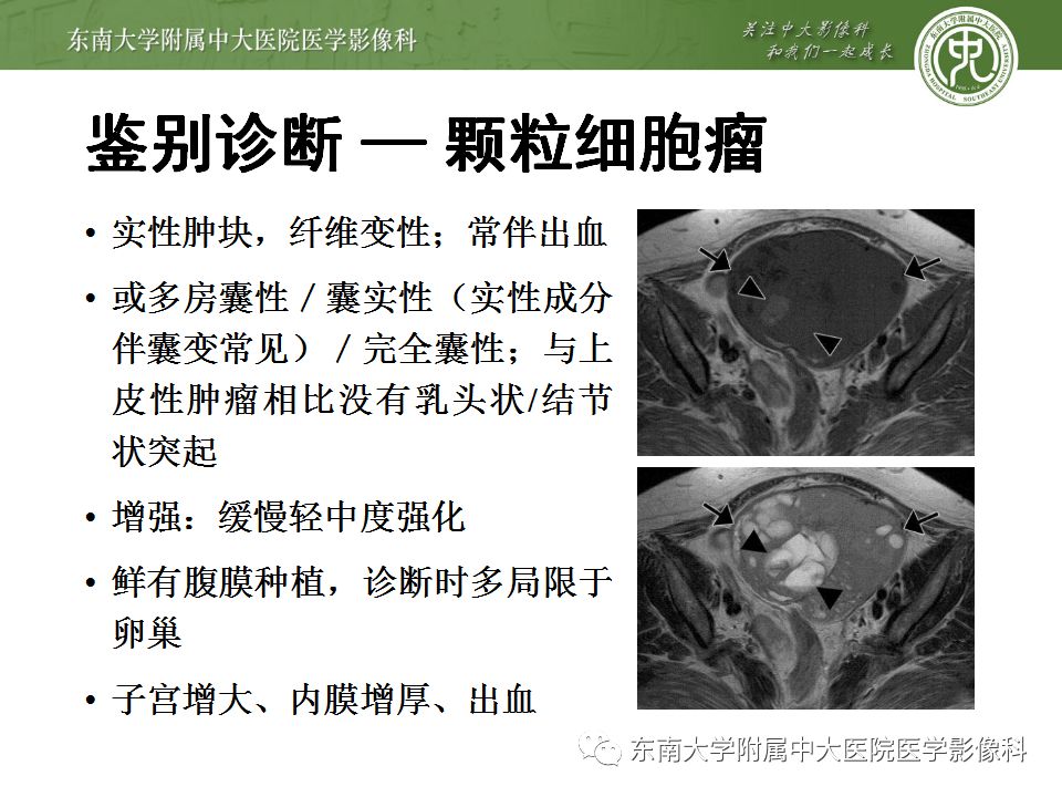 【病例】卵巢子宫内膜样癌2例MR影像表现