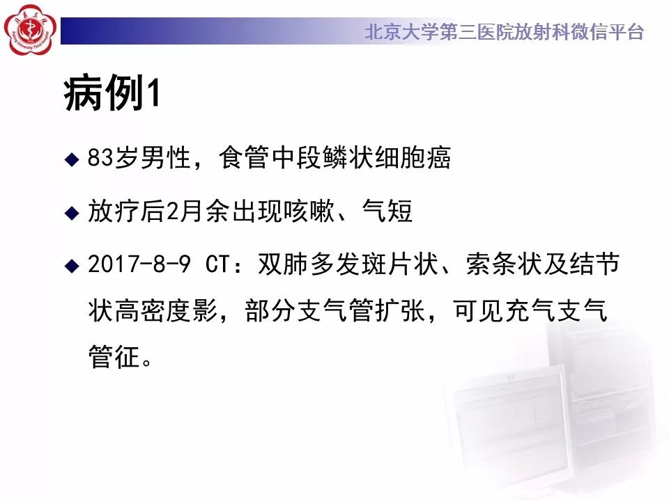 【病例】放射性肺损伤2例CT影像表现