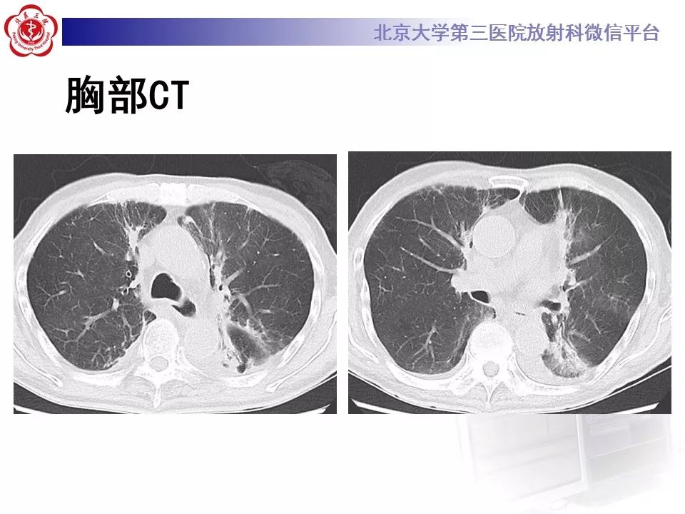 【病例】放射性肺损伤2例CT影像表现