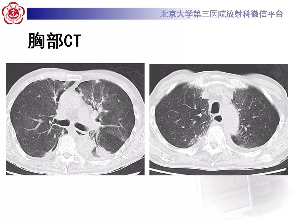 【病例】放射性肺损伤2例CT影像表现