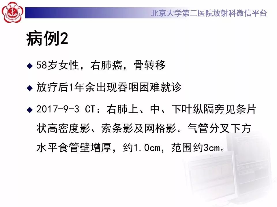 【病例】放射性肺损伤2例CT影像表现