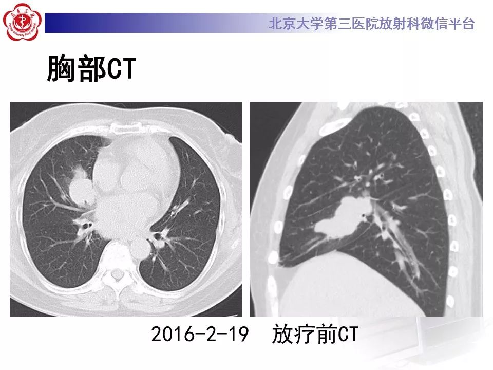 【病例】放射性肺损伤2例CT影像表现
