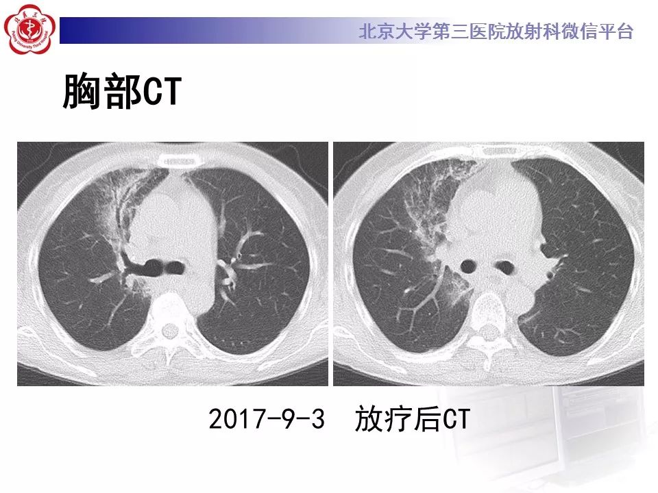 【病例】放射性肺损伤2例CT影像表现