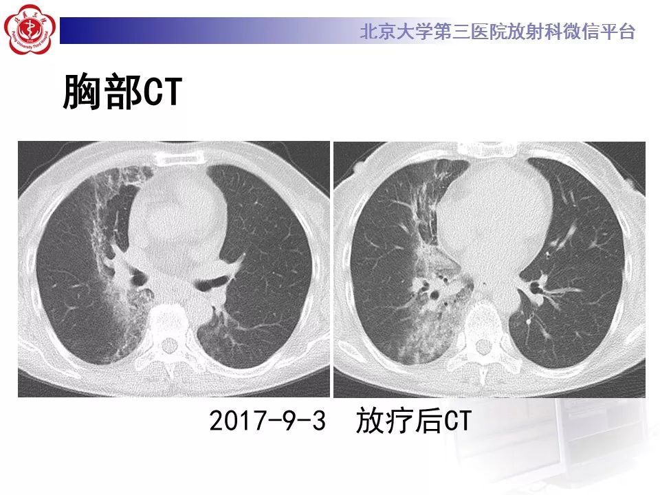 【病例】放射性肺损伤2例CT影像表现