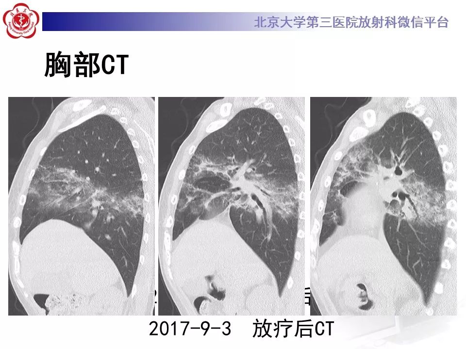 【病例】放射性肺损伤2例CT影像表现