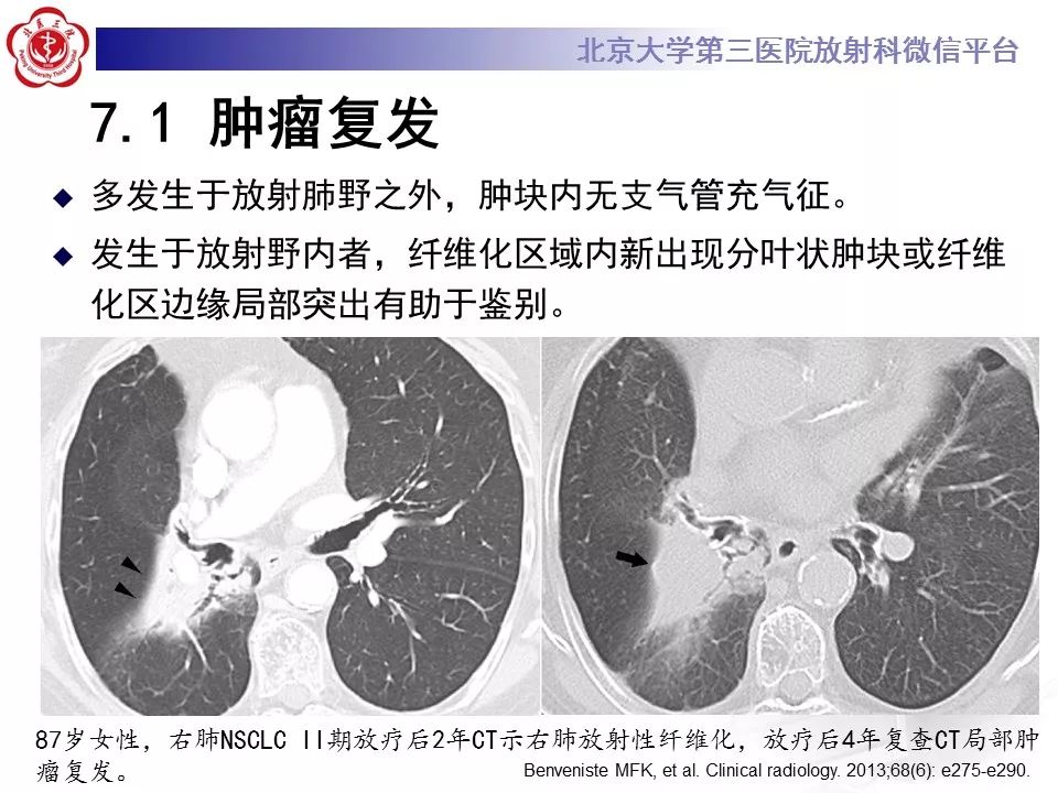 【病例】放射性肺损伤2例CT影像表现