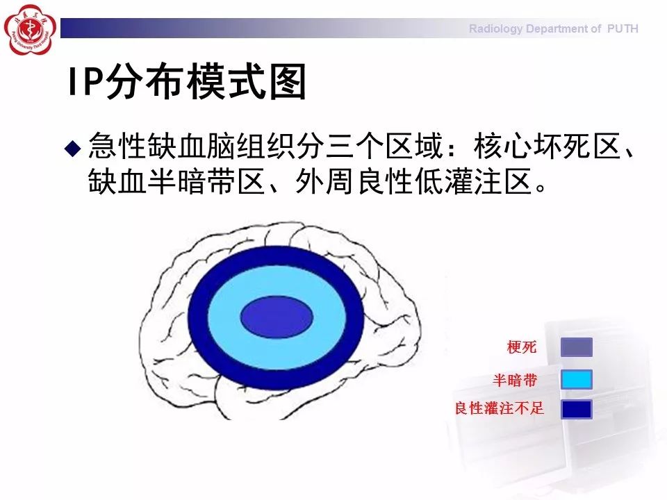 【PPT】脑CT灌注成像