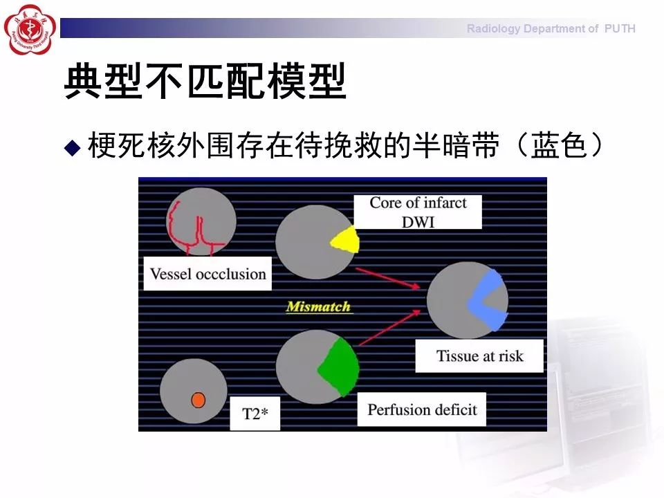 【PPT】脑CT灌注成像