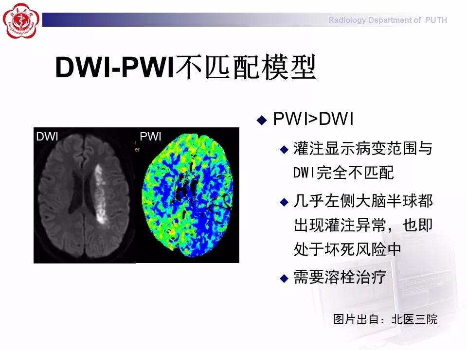 【PPT】脑CT灌注成像