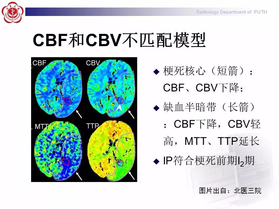 【PPT】脑CT灌注成像