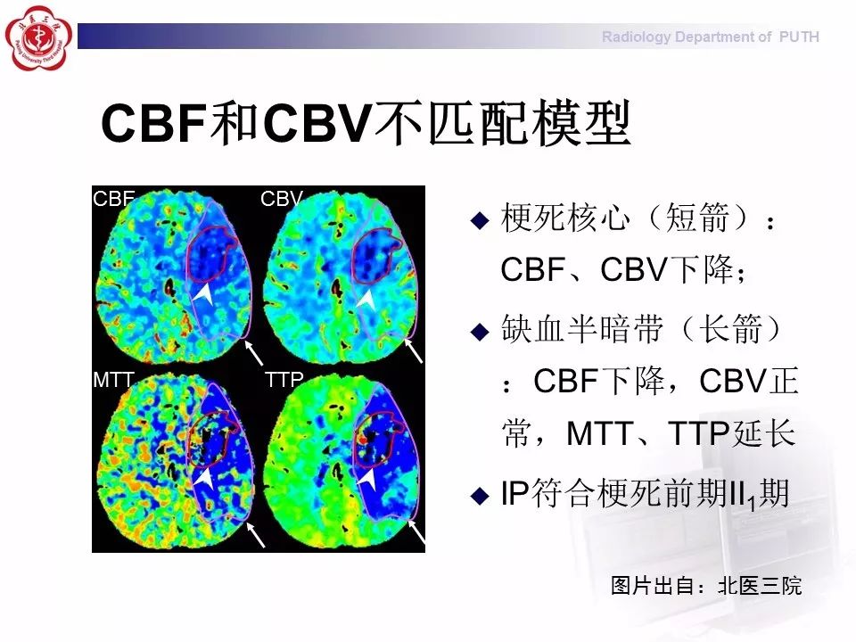 【PPT】脑CT灌注成像