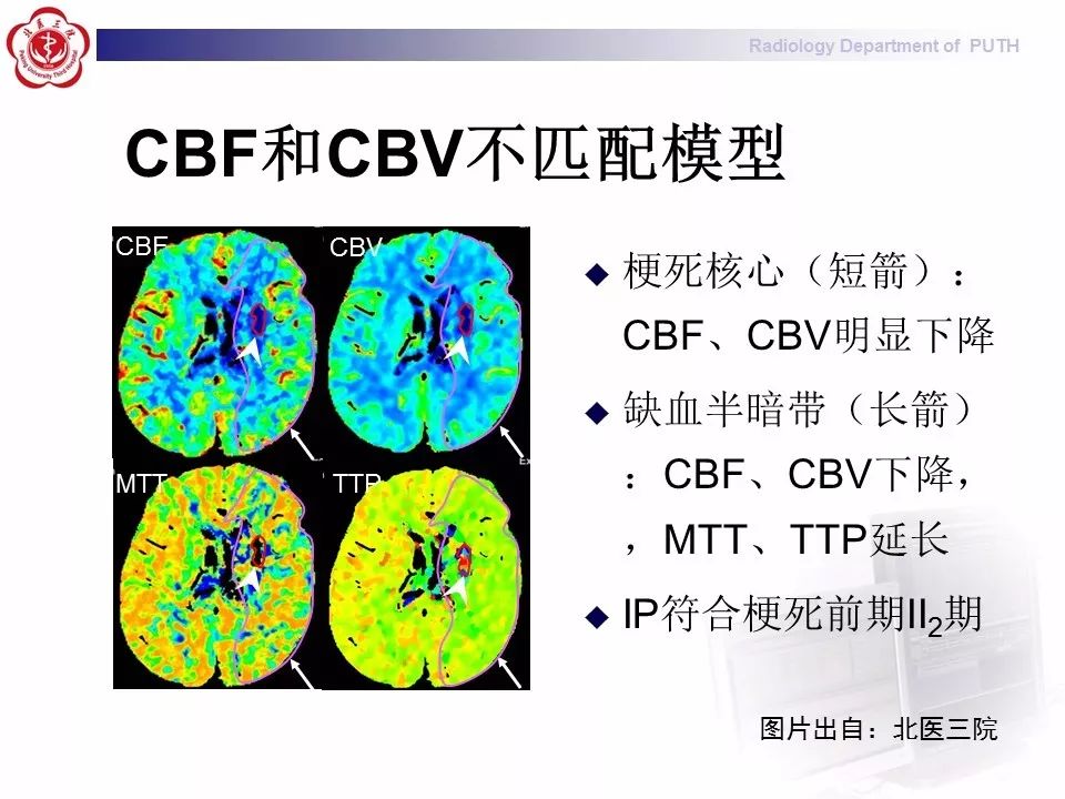 【PPT】脑CT灌注成像