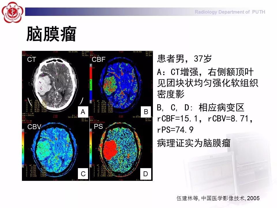 【PPT】脑CT灌注成像