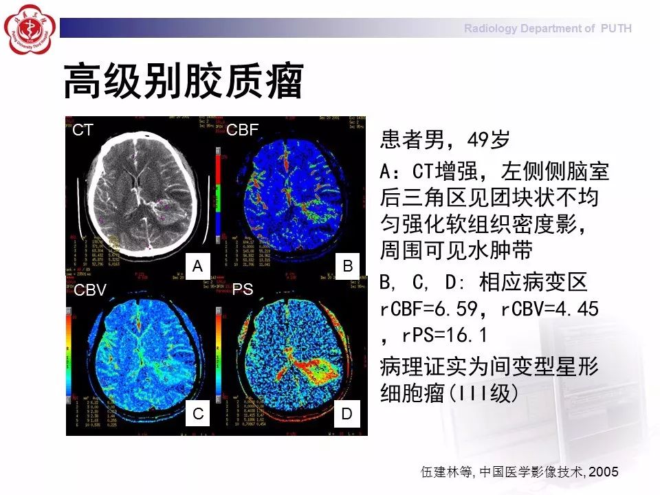 【PPT】脑CT灌注成像