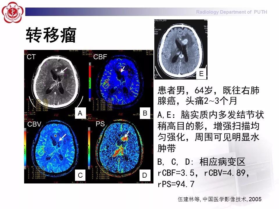 【PPT】脑CT灌注成像