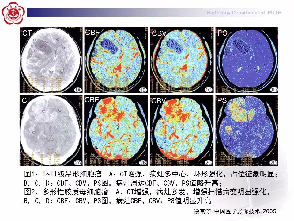 【PPT】脑CT灌注成像