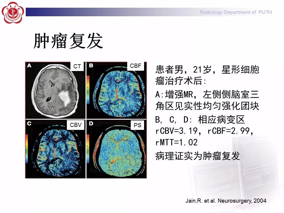 【PPT】脑CT灌注成像