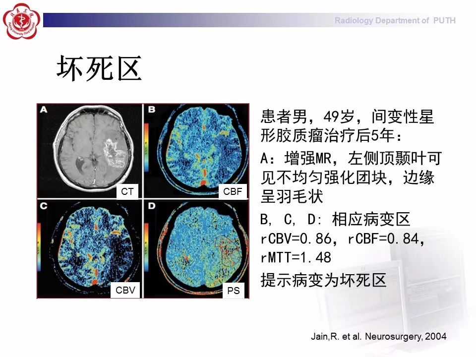 【PPT】脑CT灌注成像