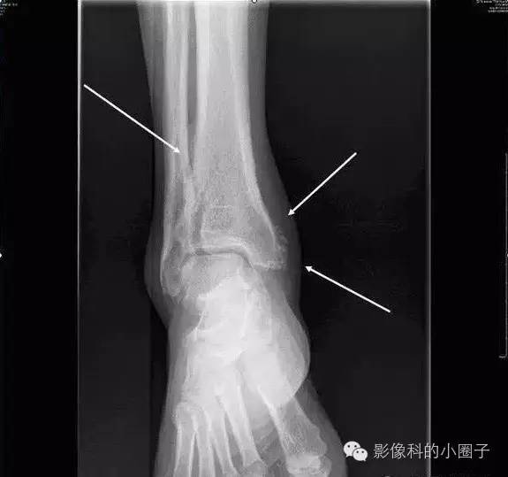 附丽病或附丽炎 附丽病或附丽炎