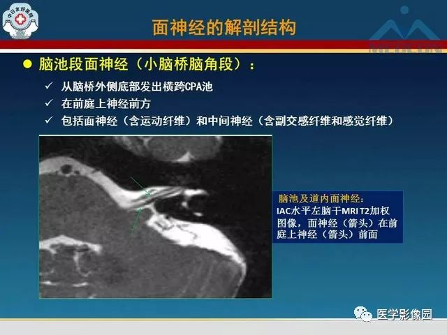【PPT】面神经病变的影像