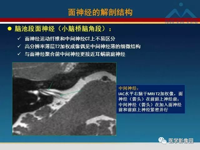 【PPT】面神经病变的影像